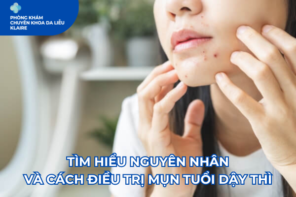 TÌM HIỂU NGUYÊN NHÂN VÀ CÁCH ĐIỀU TRỊ MỤN TUỔI DẬY THÌ