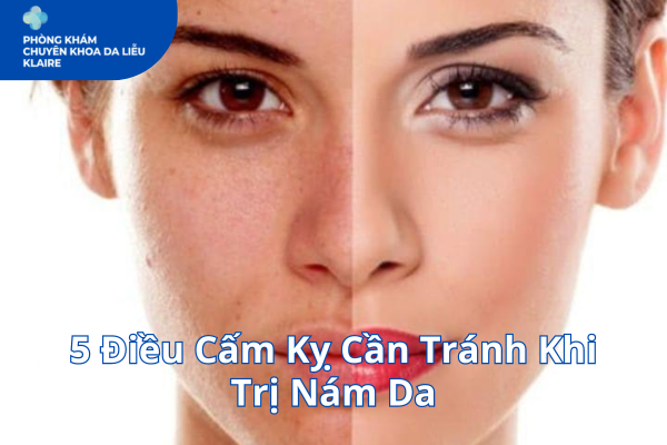 5 Điều Cấm Kỵ Cần Tránh Khi Trị Nám Da
