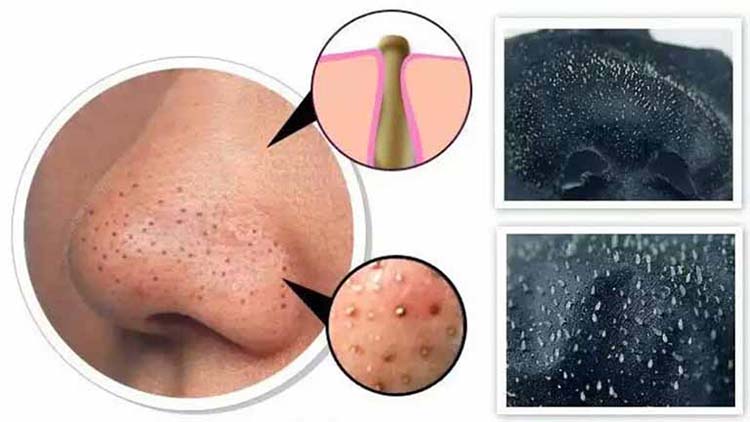 Cách xử lý trị mụn đầu đen và sợi bã nhờn hiệu quả chuẩn y khoa