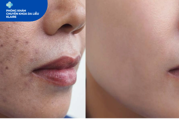 Cẩm Nang Trị Nám Hà Đông: Hiểu Đúng, Chăm Đúng Để Da Sáng Đều Màu