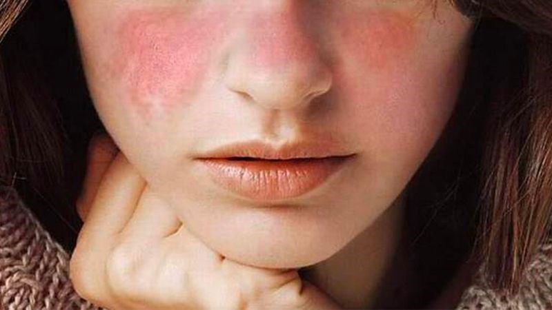 Dị ứng mỹ phẩm – Dấu hiệu nhận biết & xử lý kịp thời