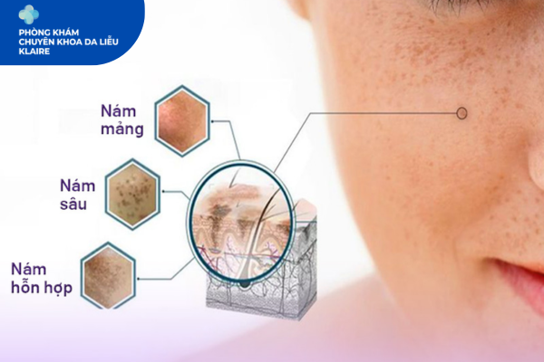 Trị Nám Tại Klaire Clinic Hà Đông: Đánh Thức Làn Da Sáng Mịn