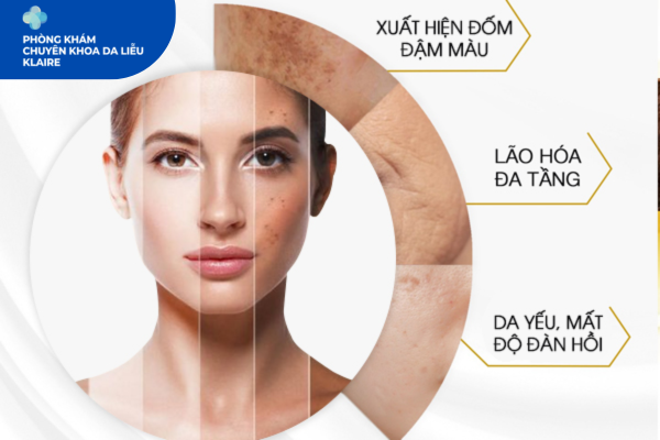 Trị Nám Không Xâm Lấn Chuẩn Y Khoa Tại Klaire Clinic Hà Đông