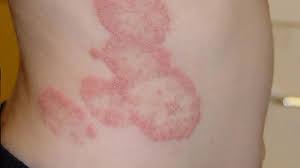 Nấm da: Nguyên nhân, triệu chứng và cách điều trị
