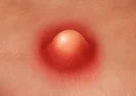 Điều trị mụn cho người có da khô