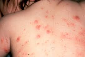 Bệnh ghẻ và điều trị đúng cách