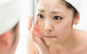 Có nên nặn mụn không? Nặn mụn chuẩn y khoa là gì?