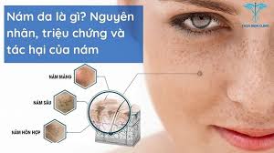 Nám da là gì? Nguyên nhân hình thành và những lưu ý cần biết