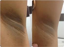 Trị thâm nách bằng laser: Loại bỏ vùng da sẫm màu nhanh chóng
