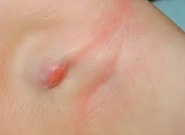 Nguyên nhân gây nổi mụn ở nách và cách điều trị hiệu quả