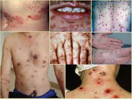 Bệnh giang mai: Nguyên nhân, đường lây, dấu hiệu nhận biết