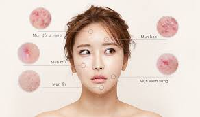 Các loại mụn trên mặt: Phân biệt, nguyên nhân & cách điều trị
