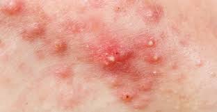 Phân biệt các loại mụn thường gặp và cách trị mụn