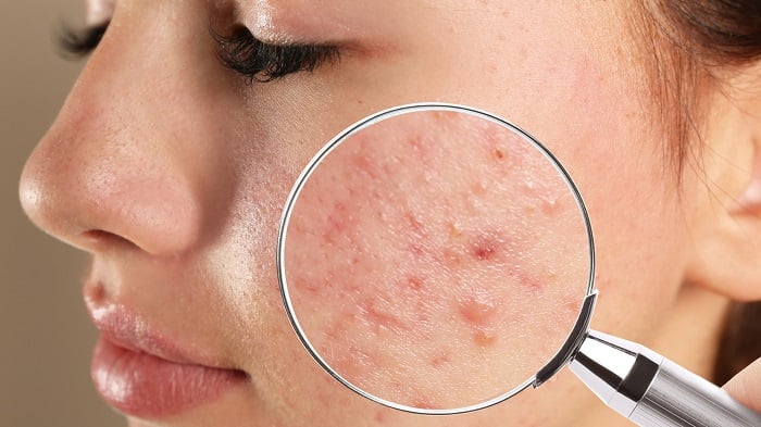 Mụn do stress – Cách điều trị và kiểm soát căng thẳng