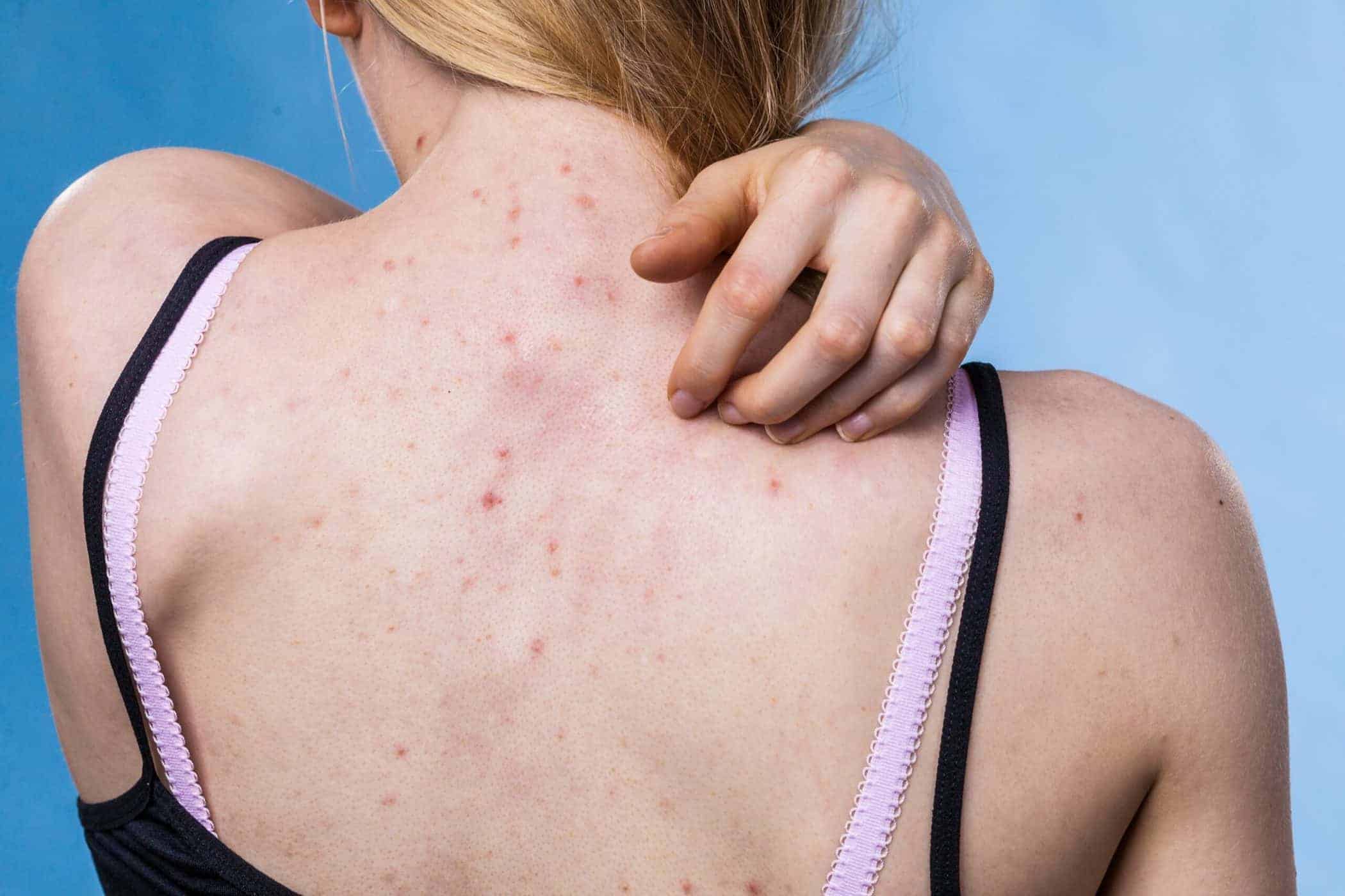 Mụn lưng: Nguyên nhân và cách khắc phục