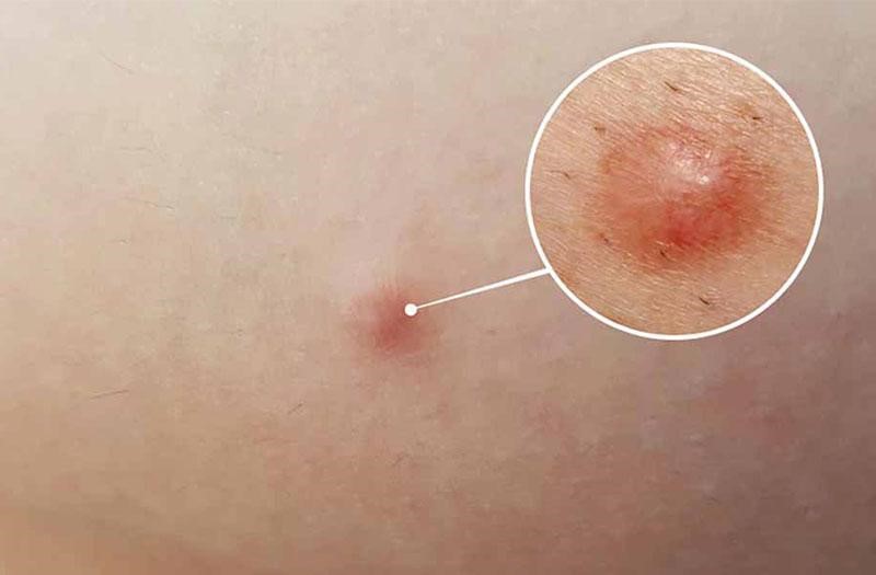 Mụn cục cứng dưới da: Đặc điểm, nguyên nhân và cách điều trị
