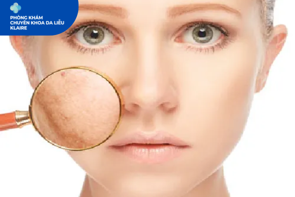 Điều Trị Nám Da Chuẩn Y Khoa Tại Klaire Clinic Hà Đông