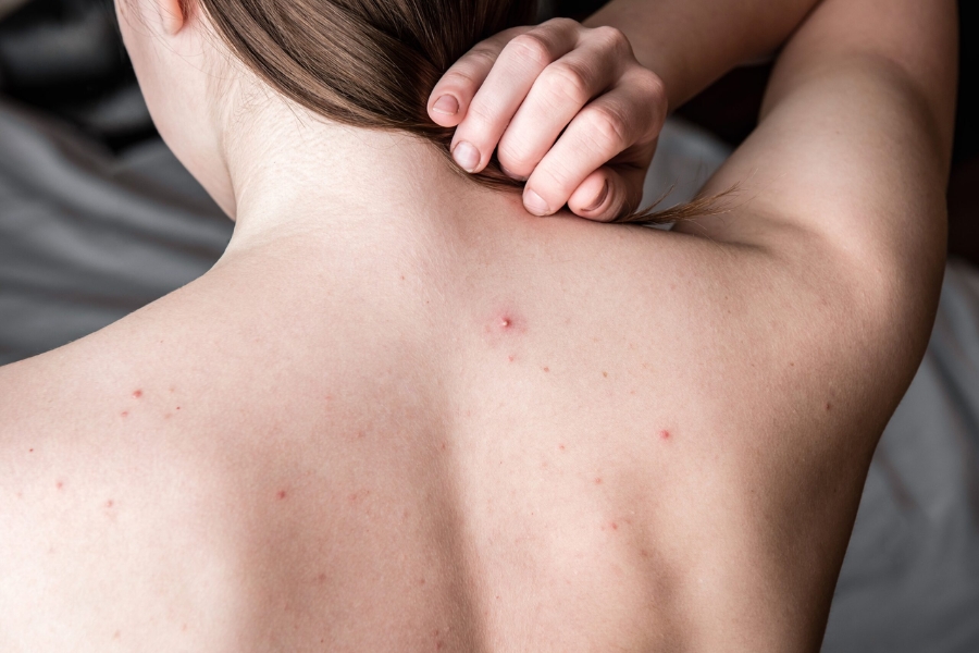 Mụn lưng: Nguyên nhân và cách khắc phục