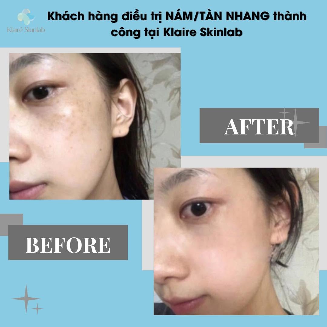 Trị Nám Trẻ Hóa Tái Sinh Làn Da Tại Klaire Clinic Hà Đông