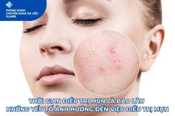THỜI GIAN ĐIỀU TRỊ MỤN LÀ BAO LÂU | NHỮNG YẾU TỐ ẢNH HƯỞNG ĐẾN VIỆC ĐIỀU TRỊ MỤN