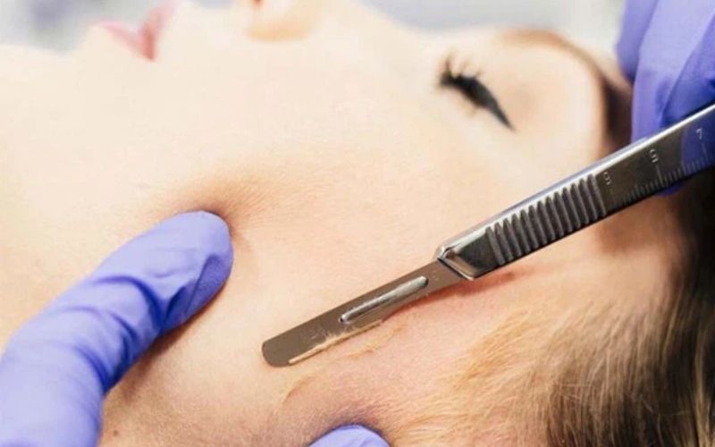 Góc giải đáp thắc mắc: Làn da mụn có nên cạo lông mặt không?
