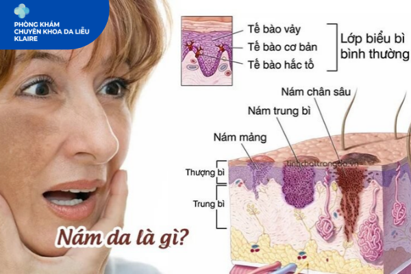 Nám Da Là Gì? Nguyên Nhân & Lưu Ý Cần Biết | Klaire Clinic