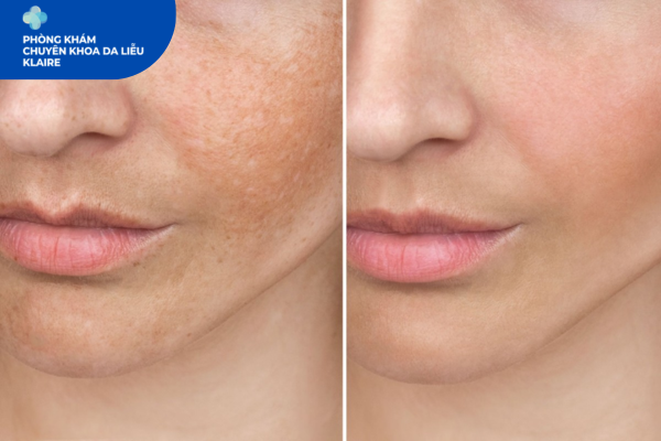 Trị Nám Klaire Clinic: Vì Sao Càng Chăm Da, Nám Càng Khó Mờ?