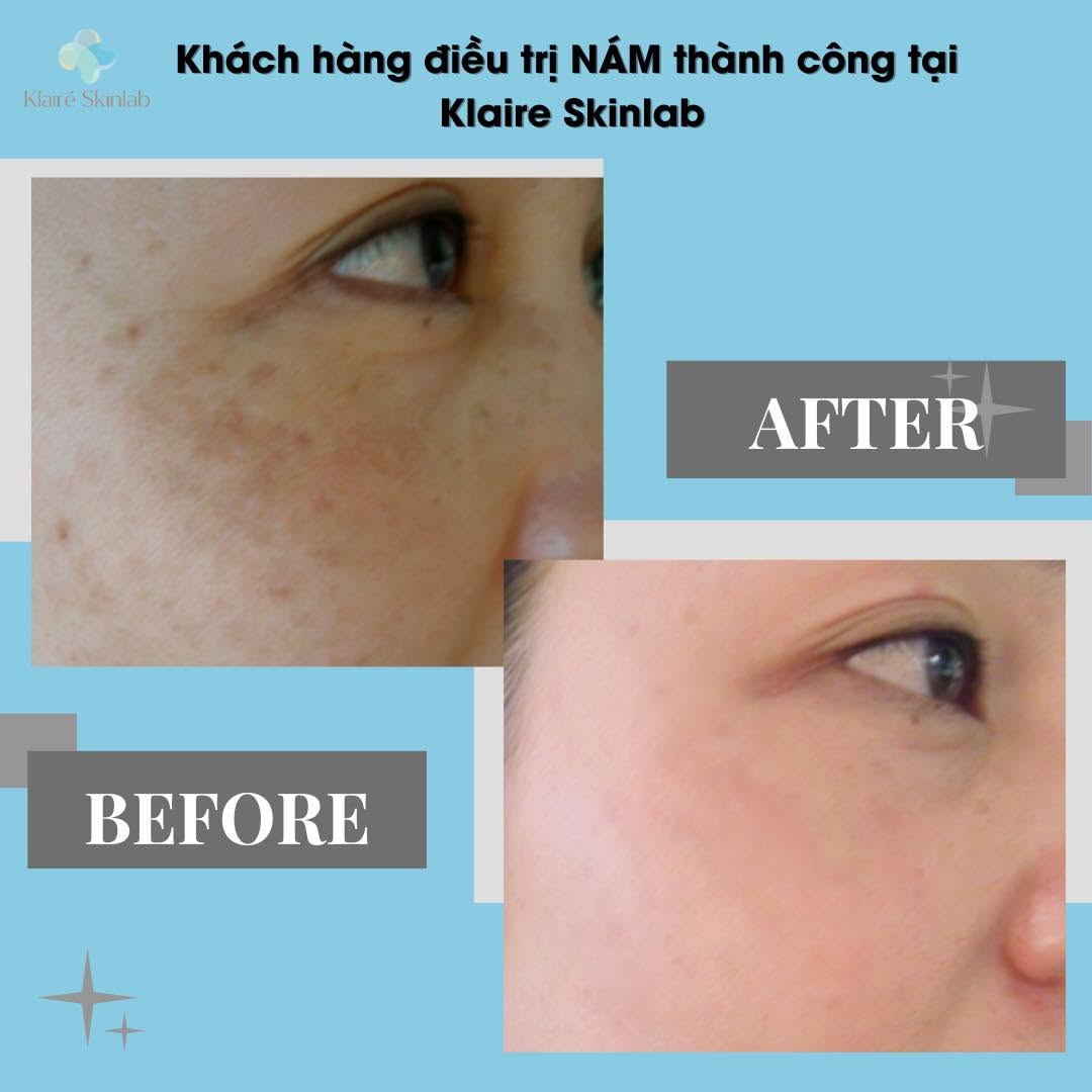 Trị nám hiệu quả giá rẻ tại Hà Nội | Thời gian điều trị nám bao lâu?