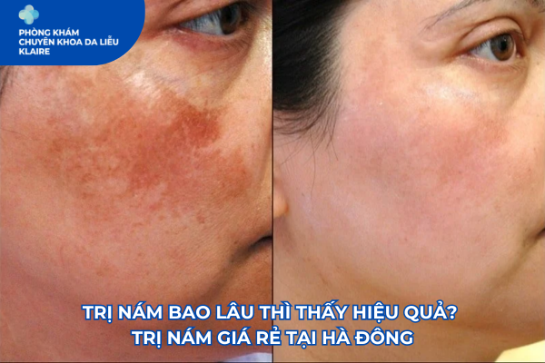 Trị nám bao lâu thì thấy hiệu quả? Trị nám giá rẻ tại Hà Đông