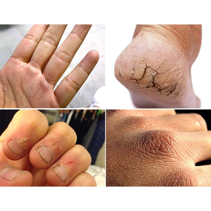 Kem trị nứt gót tay chân Shiseido 100g