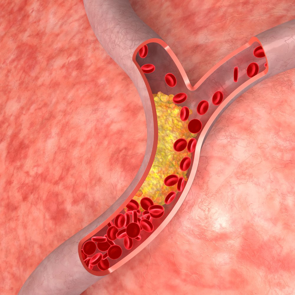 Uống nước gì để giảm mỡ máu an toàn, tự nhiên?