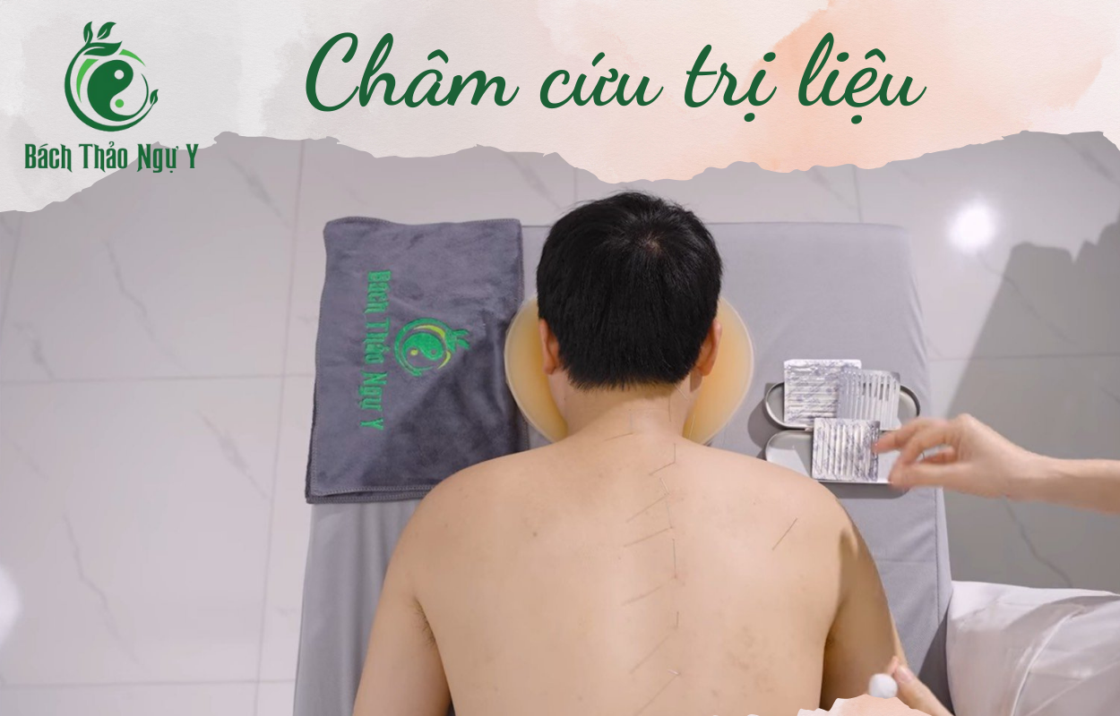 Châm cứu trị liệu