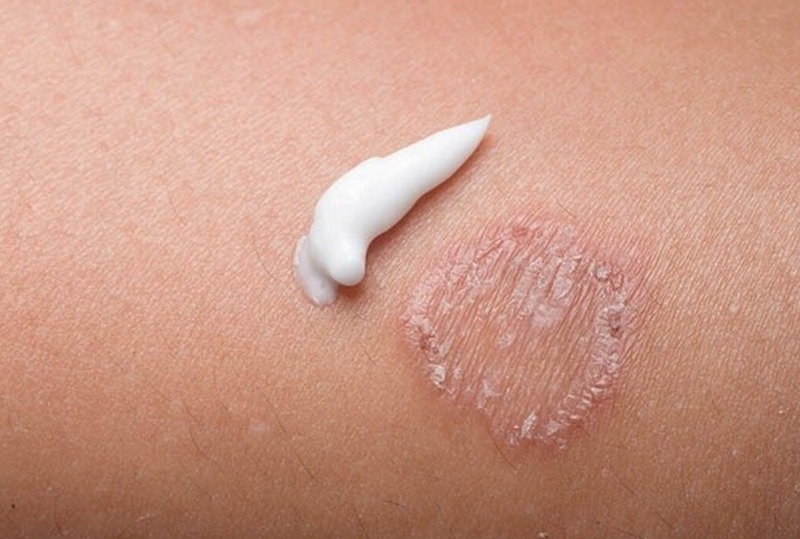 Tham khảo các loại thuốc trị lác đồng tiền hiệu quả