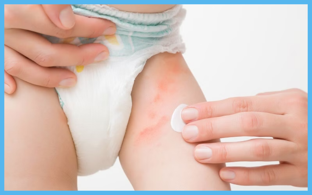 Đóng bỉm có phải nguyên nhân chính khiến bé bị hăm không?