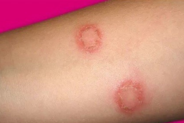 Nấm da ở trẻ nhỏ: Dấu hiệu nhận biết và cách phòng ngừa