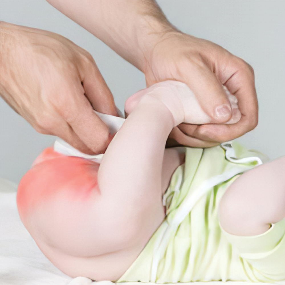 Hăm tã ở trẻ nhỏ: Nguyên nhân, triệu chứng, cách ngăn ngừa và cách điều trị hiệu quả