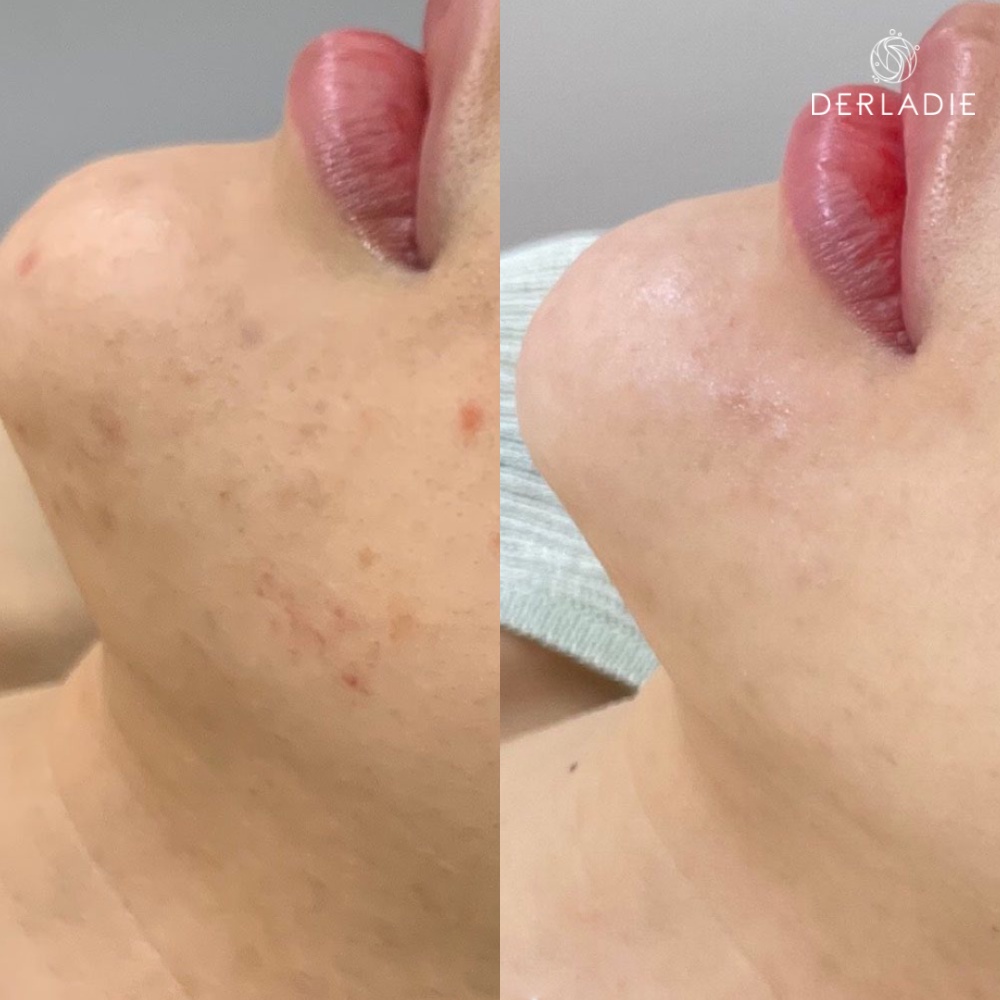Bộ sản phẩm Tẩy trang, Serum, Kem dưỡng Derladie làm sạch, giảm mụn, thu nhỏ LCL dành cho da dầu mụn