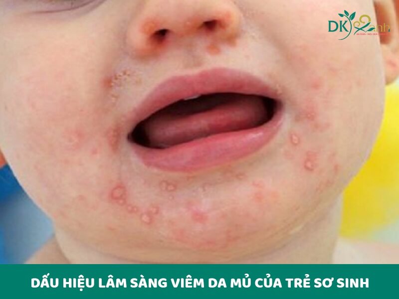 Dấu hiệu lâm sàng viêm da mủ của trẻ sơ sinh