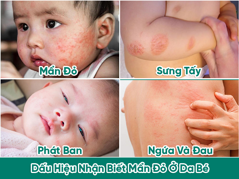 Dấu hiệu nhận biết mẩn đỏ ở da bé