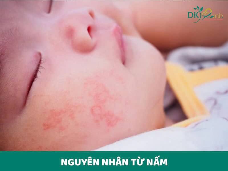 Nguyên nhân từ nấm