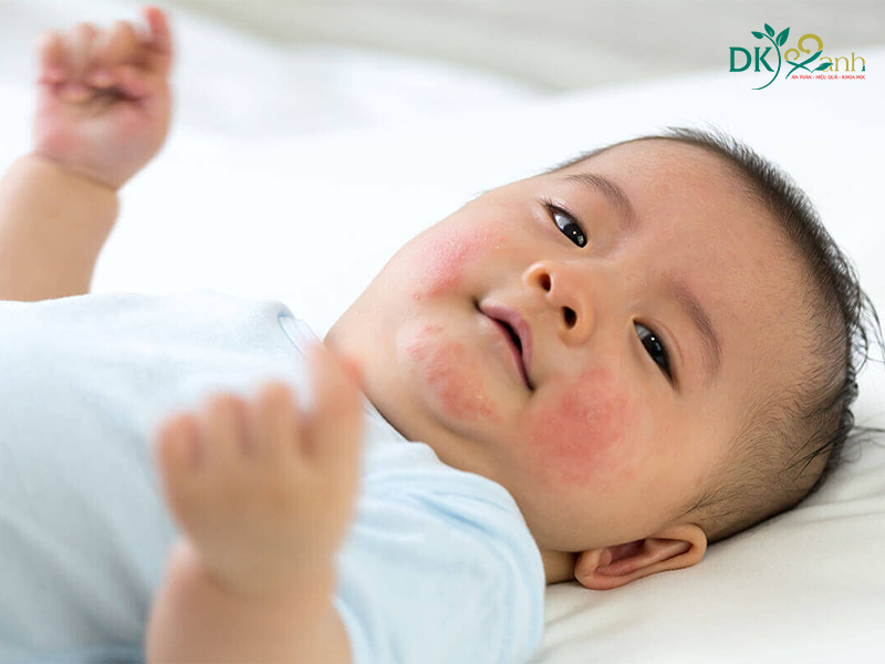 rôm sảy có các mảng màu hồng