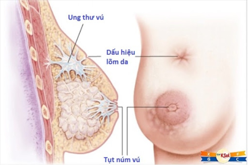 Thay đổi hình dạng núm vú