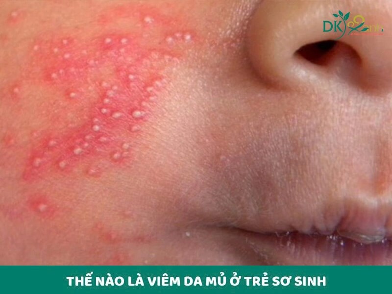 Thế nào là viêm da mủ ở trẻ sơ sinh