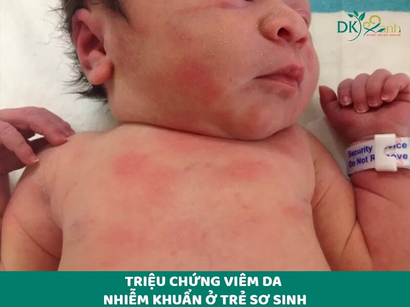 Triệu chứng viêm da nhiễm khuẩn ở trẻ sơ sinh