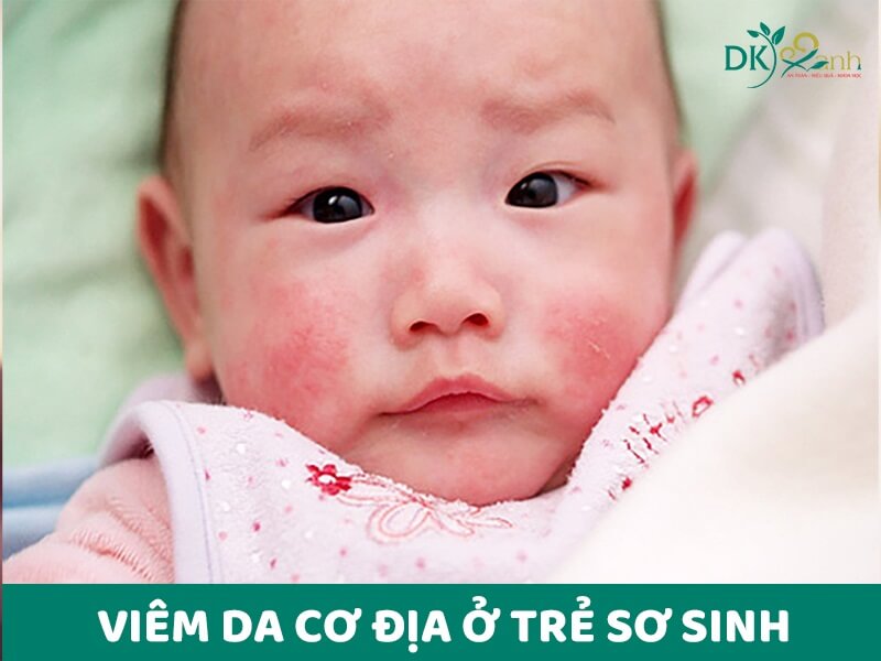 Viêm da cơ địa ở trẻ sơ sinh