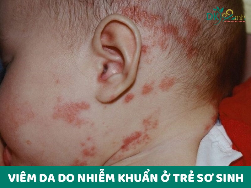 Viêm da do nhiễm khuẩn ở trẻ sơ sinh