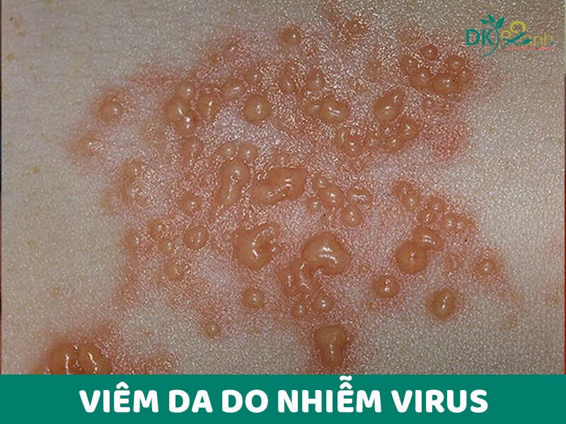 Viêm da do nhiễm virus