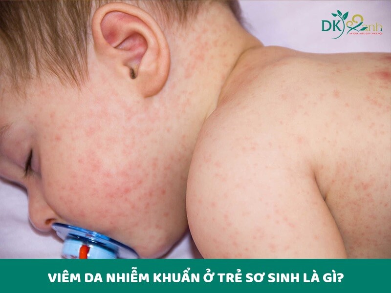 Viêm da nhiễm khuẩn ở trẻ sơ sinh là gì