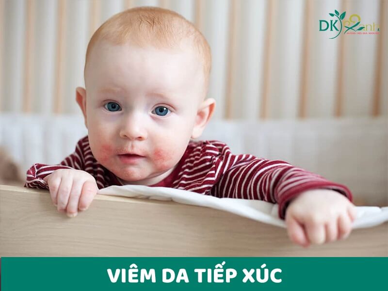 Viêm da tiếp xúc