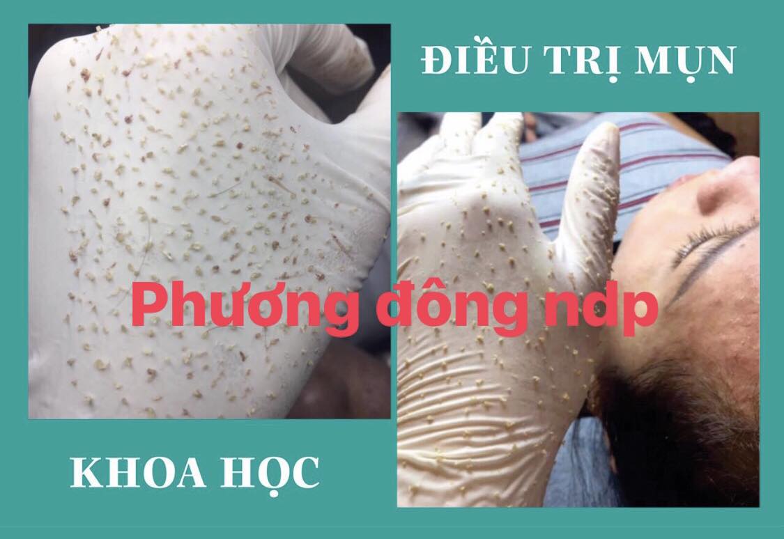 TRỊ MỤN TẬN GỐC VỚI QUY TRÌNH CHUẨN Y KHOA